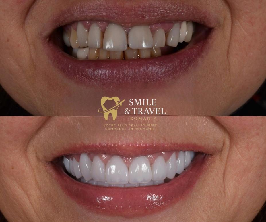 Patiente implants Roumanie